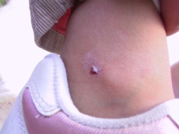 wound.jpg
